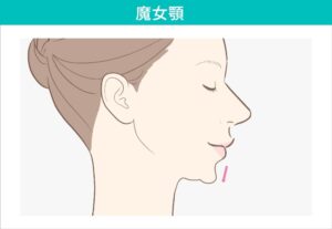 下垂した女性の顎先のイラスト
