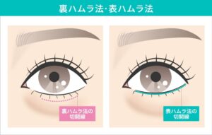 裏ハムラ法・表ハムラ法