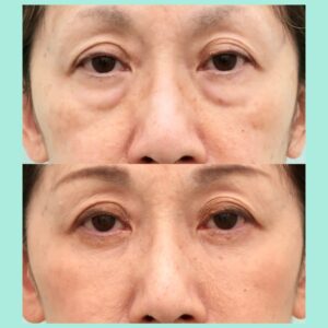 裏ハムラ法+ミッドフェイスリフトの症例写真