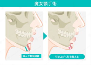 魔女顎手術の施術箇所を示す図