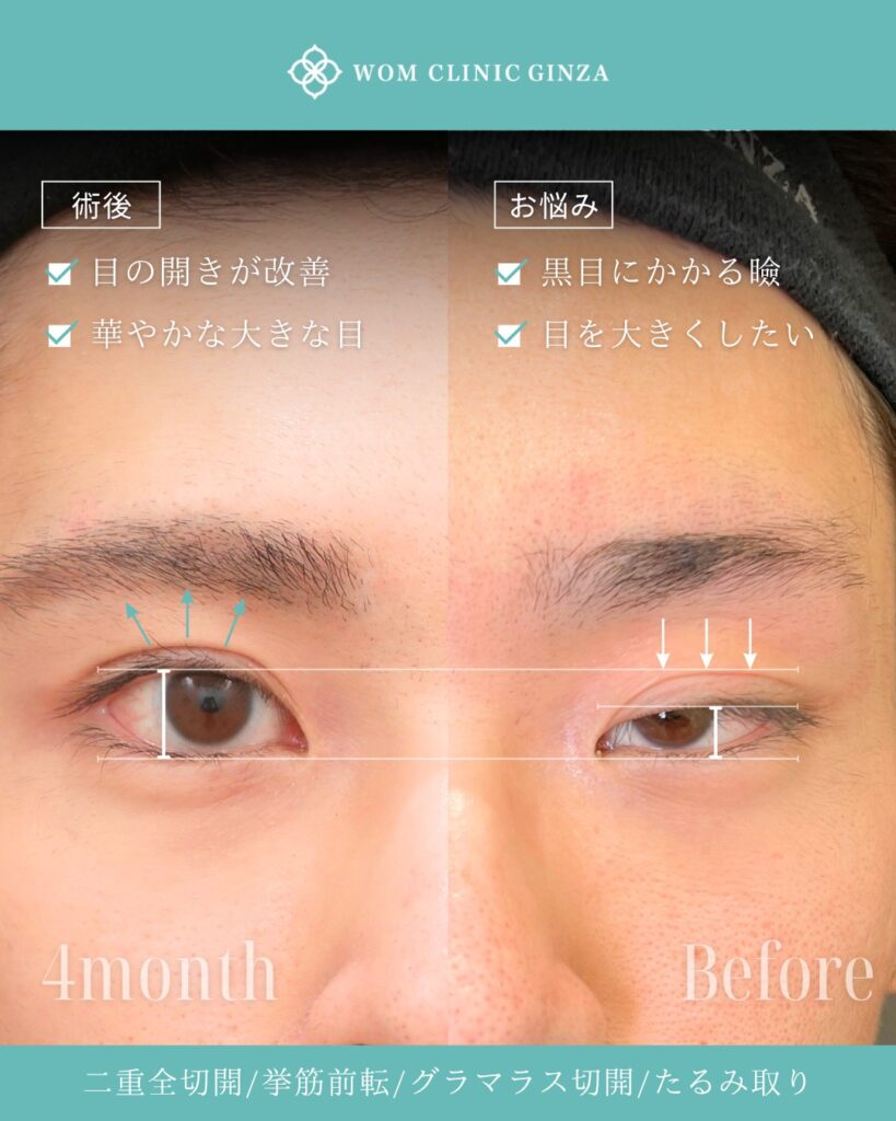 『【劇的変化】目つきの悪さを変えて、イケメンに変身!眼瞼下垂手術の驚きの効果』の画像