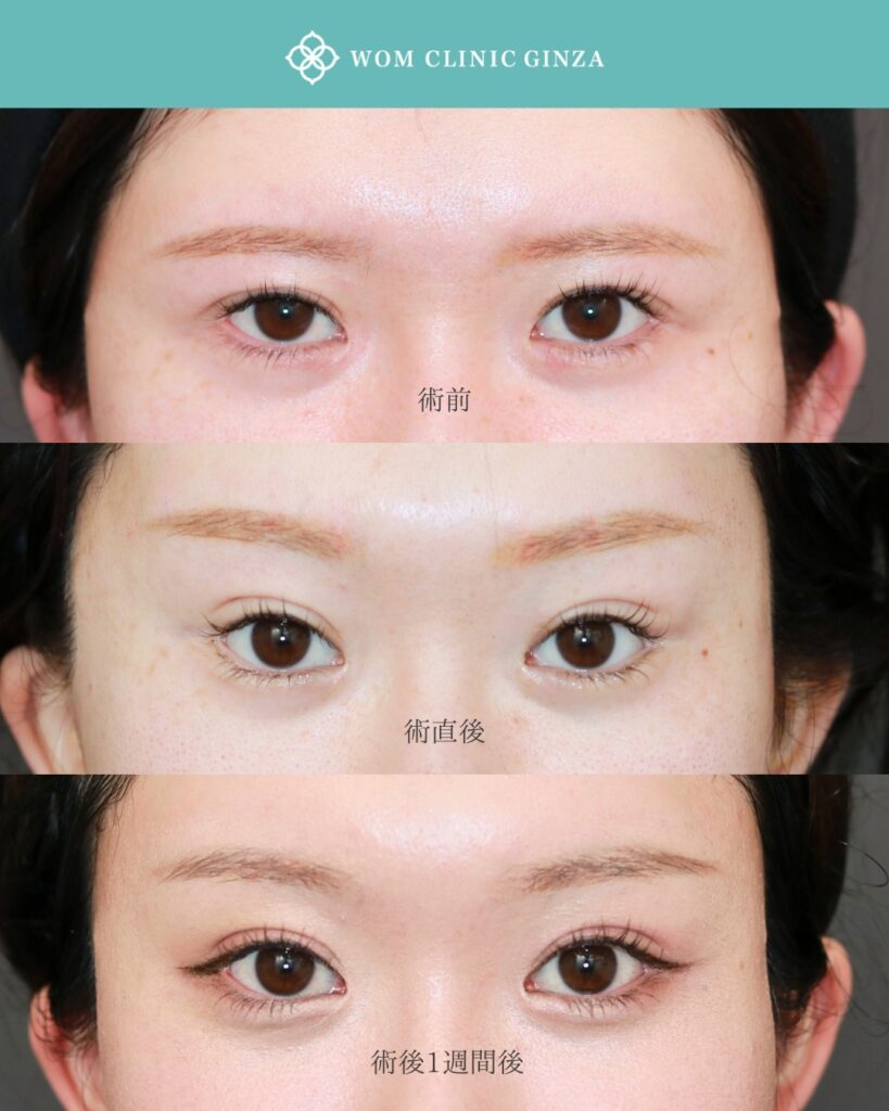 『重たい目元が一変!内視鏡額挙上で叶える