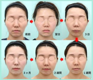 頬骨削りのダウンタイムの経過