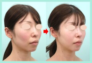 頬の脂肪注入の症例写真