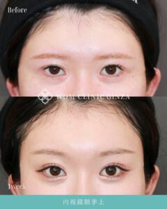 前額リフト（内視鏡額挙上）の症例写真03