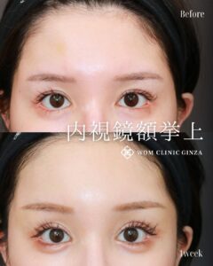 前額リフト（内視鏡額挙上）の症例写真03