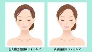 内視鏡額挙上の傷跡