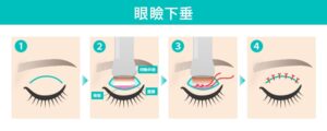眼瞼下垂