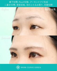 眉下切開＋ROOF切除＋アーモンドアイ形成＋二重全切開＋挙筋前転＋目の上たるみ取り＋目頭切開の症例写真