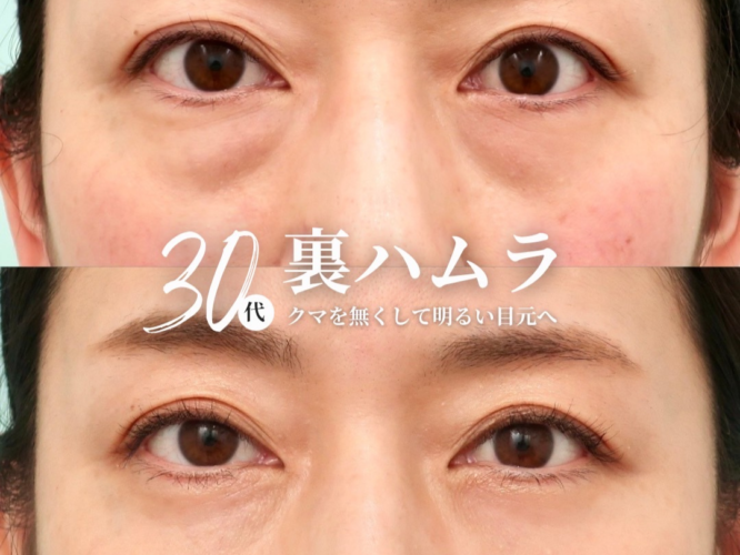 裏ハムラ法