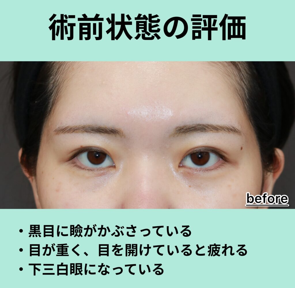 『三白眼の原因は眼瞼下垂だった!?』の画像