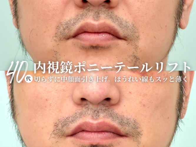 ポニーテールリフト