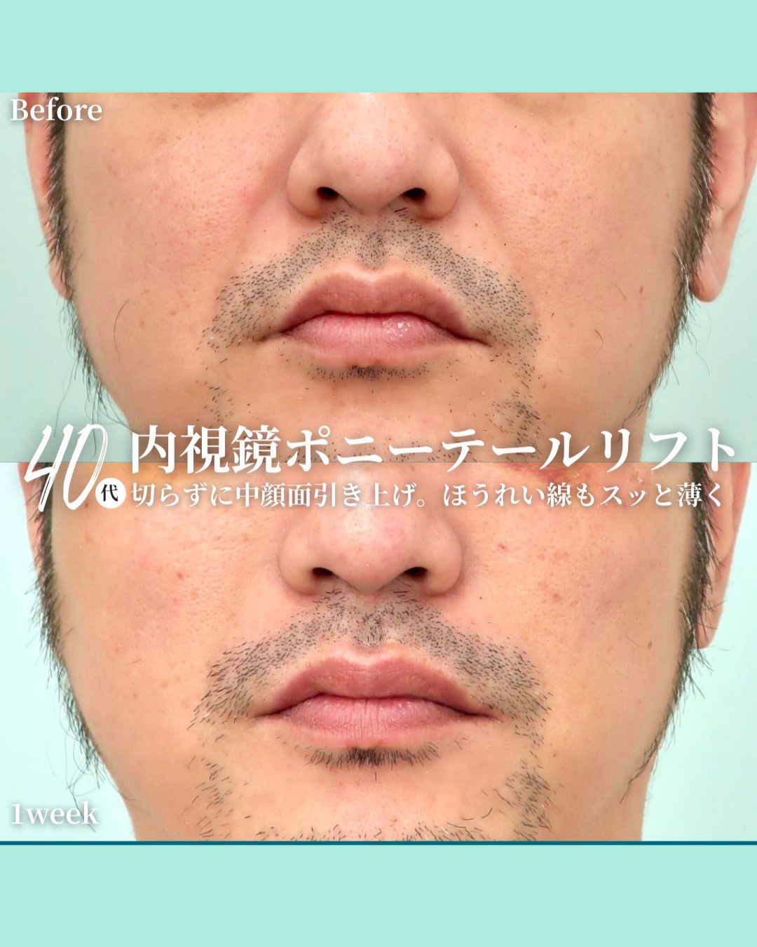 ポニーテールリフト