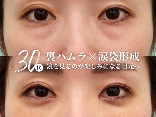 裏ハムラ法