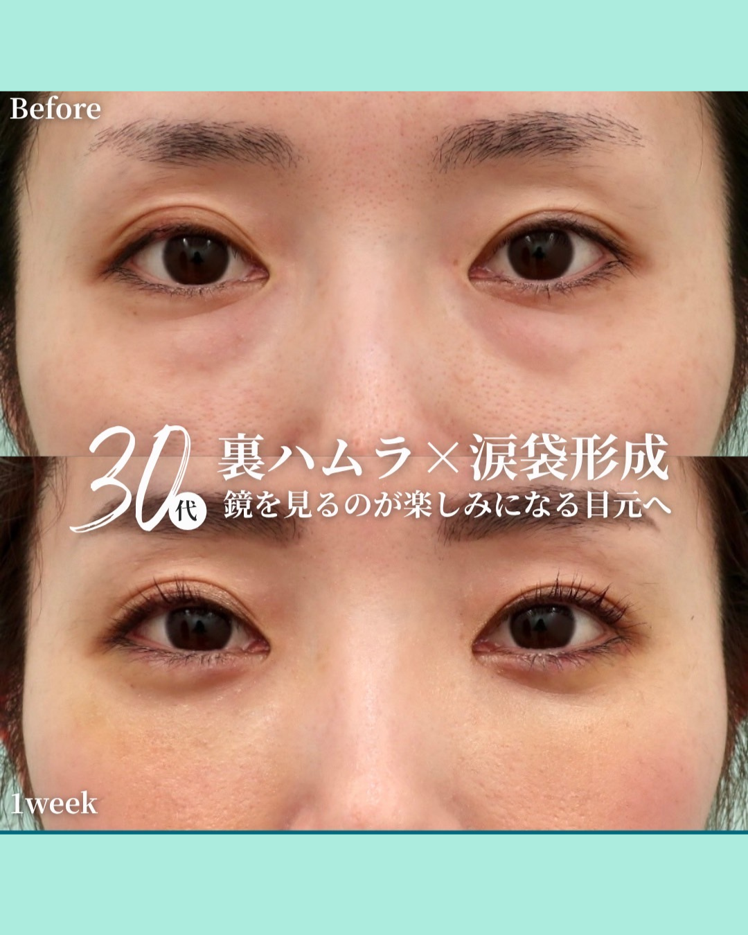 裏ハムラ法