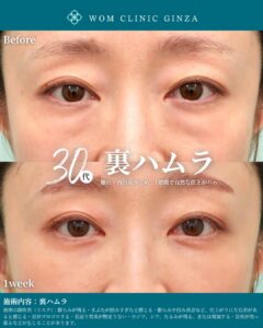 『裏ハムラ法で“可愛さ”を仕上げる|クマ取りと涙袋形成の最新美容外科』の画像