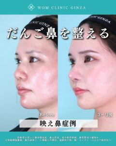 映え鼻の症例写真