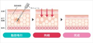 拘縮