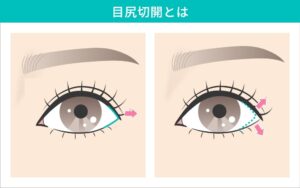 目尻切開
