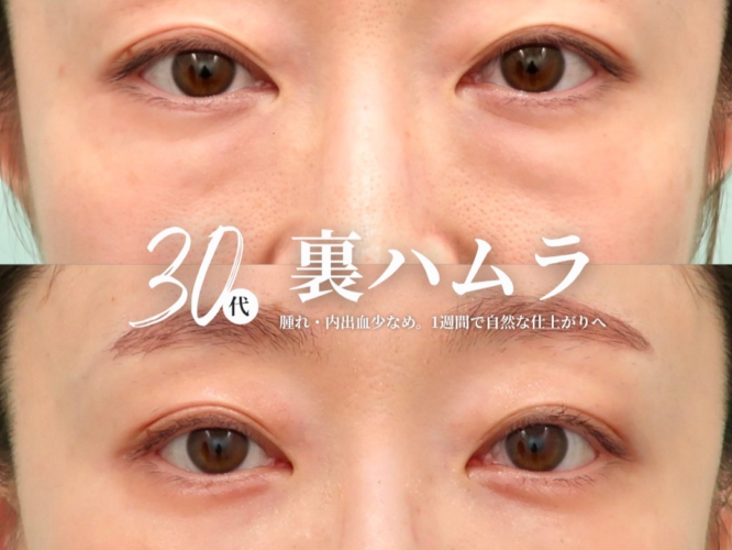 裏ハムラ