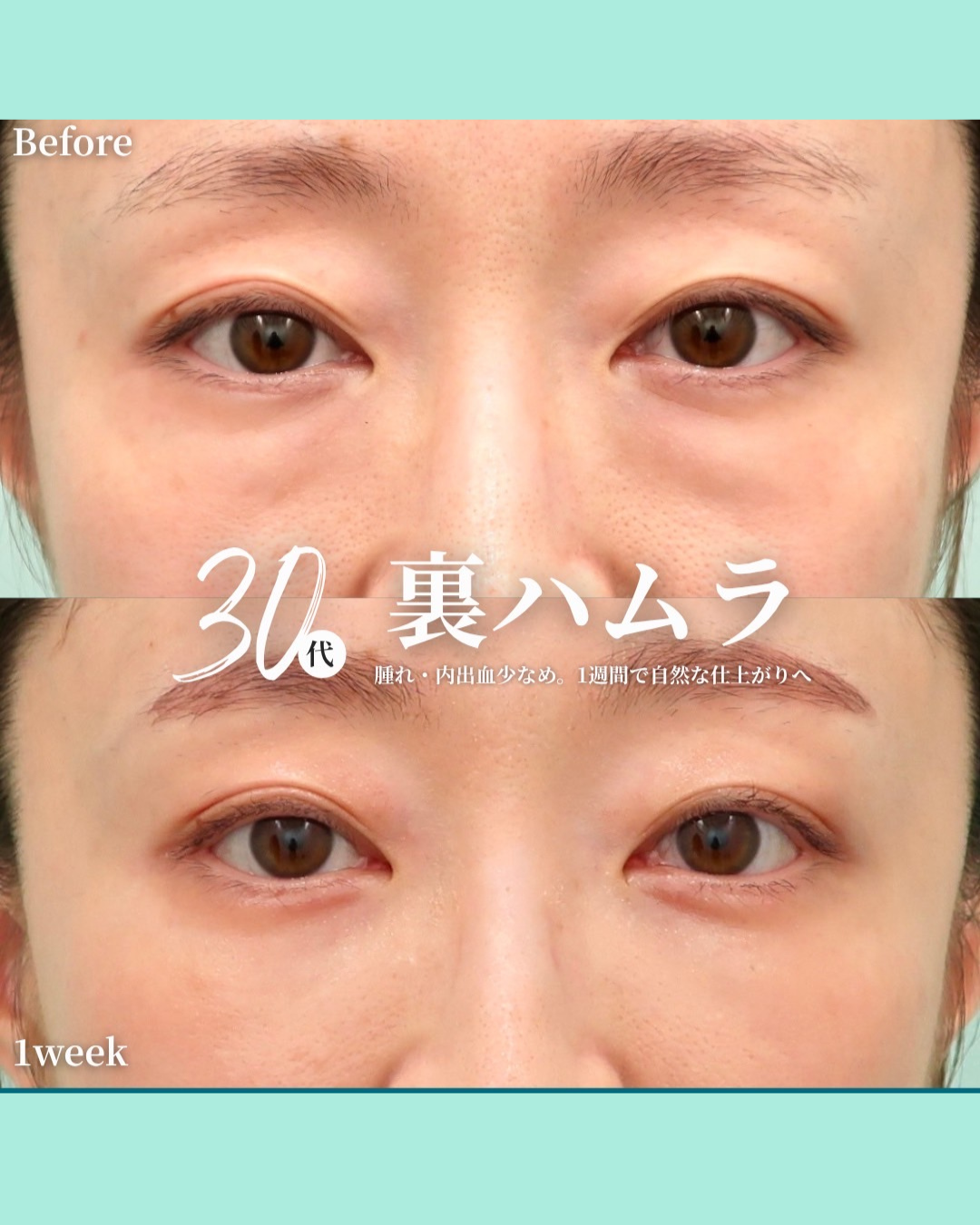裏ハムラ