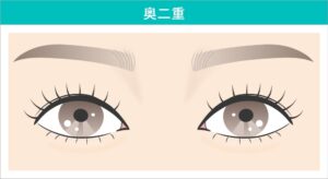 奥二重
