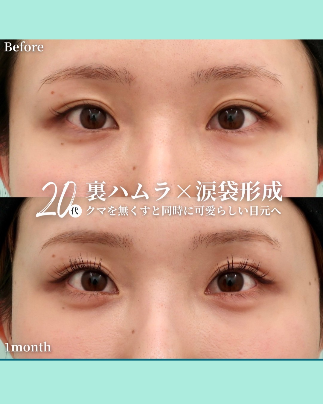 裏ハムラ、涙袋形成