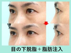 目の下脂肪取り（経結膜下瞼脱脂術）＋目の下の脂肪注入の症例写真