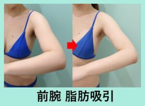 前腕の脂肪吸引の症例