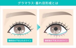 グラマラス・垂れ目形成