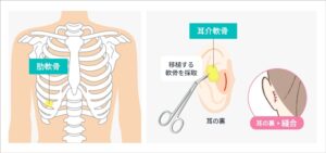 鼻孔縁下降の施術方法 STEP02