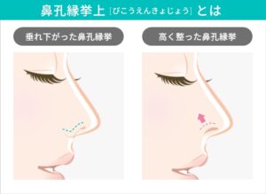 鼻孔縁挙上