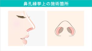 鼻孔縁挙上の施術箇所