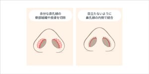 鼻孔縁挙上の施術方法 STEP02