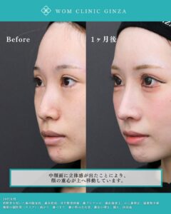 鼻フルの症例写真