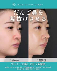 鼻尖形成＋鼻中隔延長＋鼻孔縁下降＋自家組織隆鼻術＋猫・貴族手術の症例写真