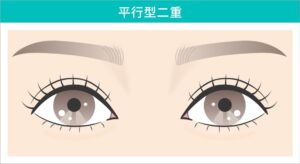 平行型二重