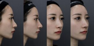 重度修正＋鼻尖形成＋耳介軟骨移植＋鼻孔縁下降の症例写真
