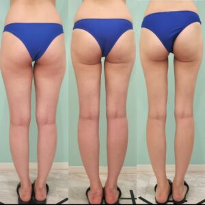 太もも全周+下臀部+膝周りの脂肪吸引の症例写真