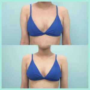 二の腕+肩+付け根の脂肪吸引の症例写真