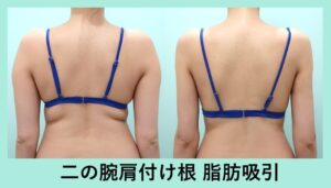 二の腕+肩+付け根の脂肪吸引の症例写真