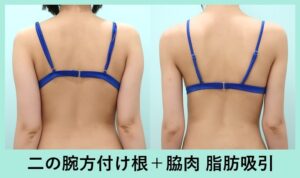 二の腕+肩+付け根+脇肉の脂肪吸引の症例写真