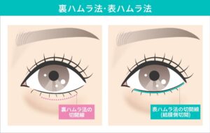 裏ハムラ法・表ハムラ法