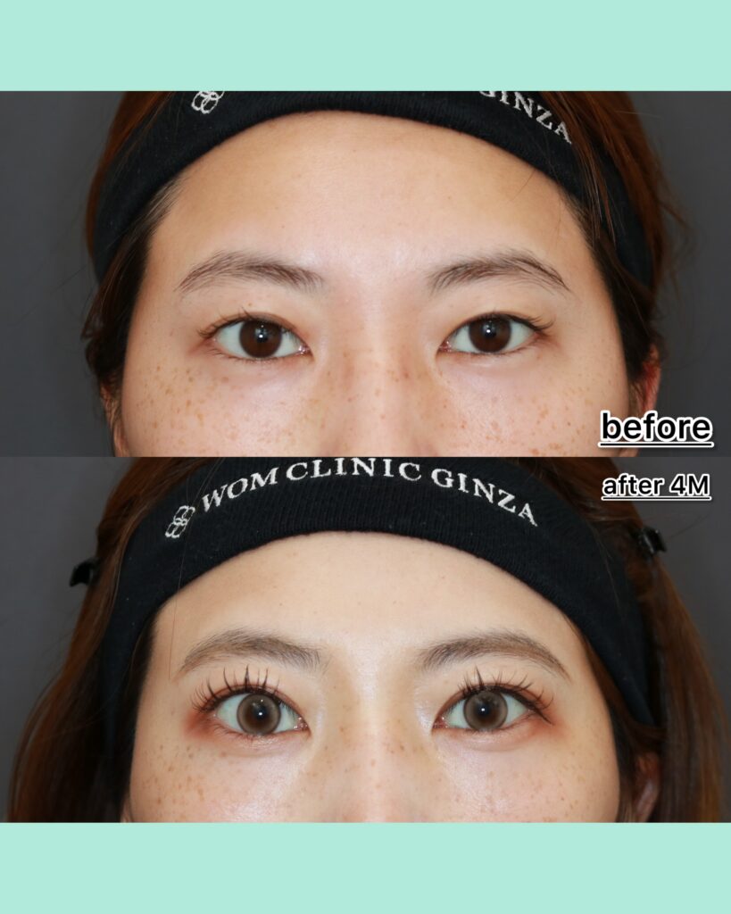 『あなたは全切開と気づきますか?自然さを突き詰めた全切開』の画像