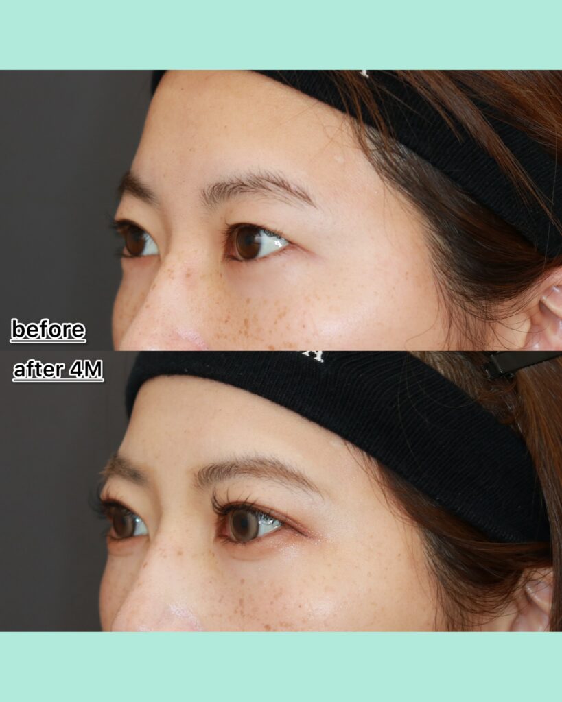 『あなたは全切開と気づきますか?自然さを突き詰めた全切開』の画像