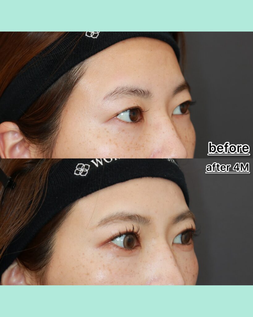 『あなたは全切開と気づきますか?自然さを突き詰めた全切開』の画像