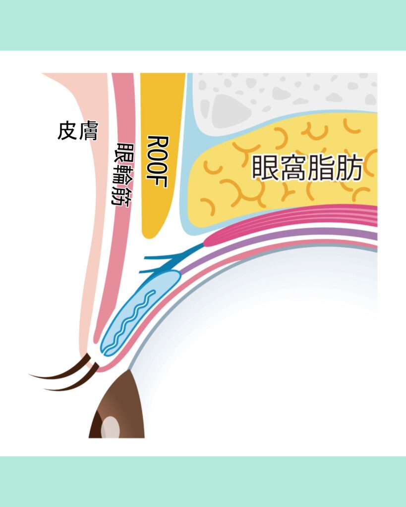 『瞼の重さを取るのに、眉下切開が最強な理由。』の画像