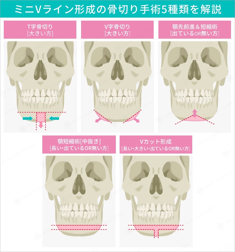 ミニVライン形成の骨切り手術5種類を解説