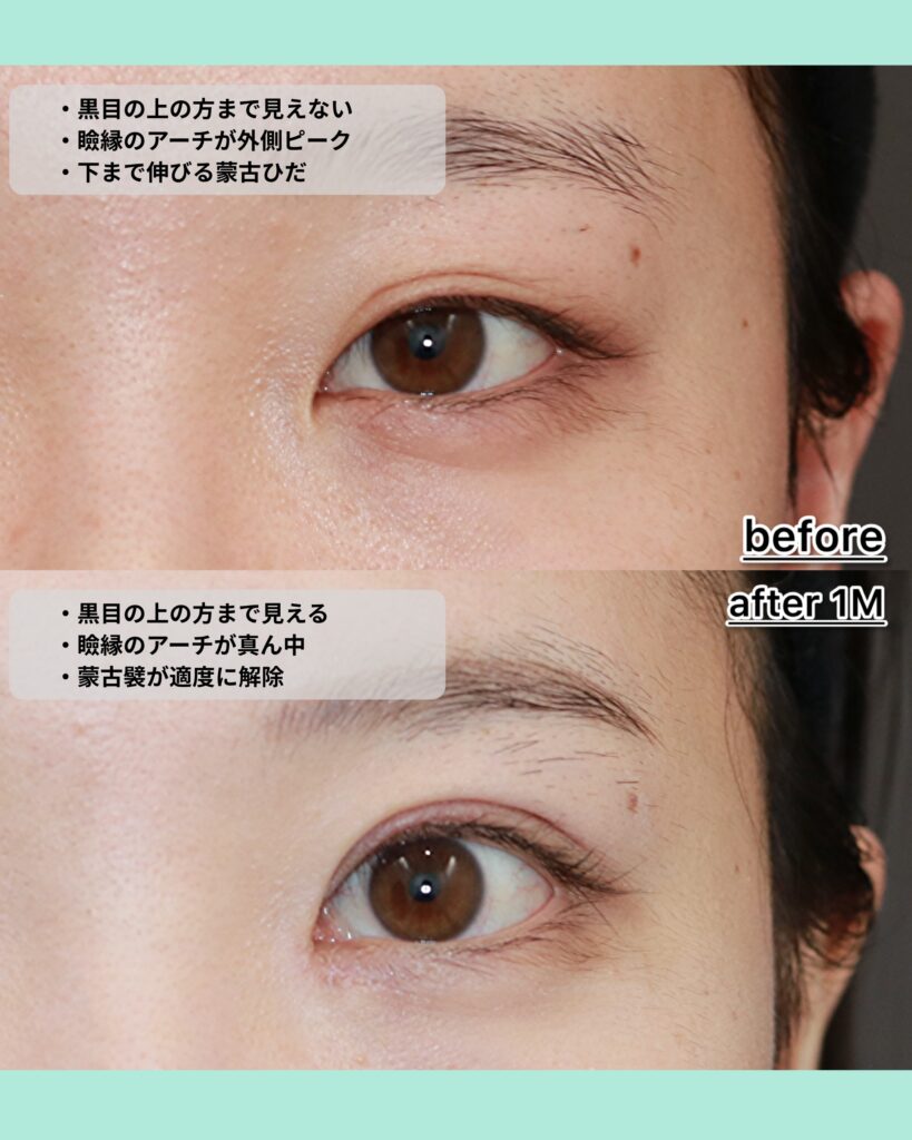 『埋没から全切開への切り替え。わざとらしくない二重とは。』の画像