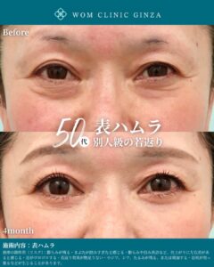 表ハムラ　涙袋